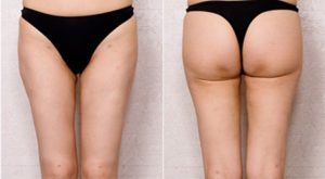 Tummy Tuck Korea: Tummy Tuck Surgery, Cost in Seoul, South Korea