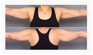 Arm Liposuction korea before and after