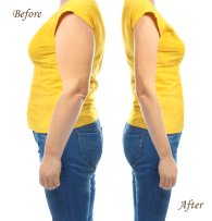 Tummy-Tuck-before-after