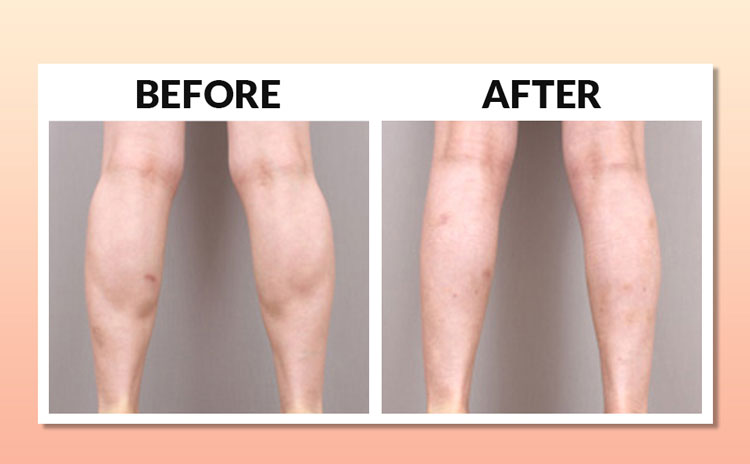 All about calf reduction