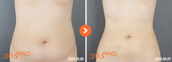 Thigh Liposuction Korea: Obesity Fatness Recovery, Cost and Benefits -  365mc Hospital