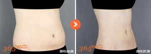 abdominal liposuction 3 