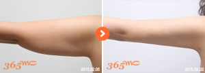 arm liposuction 1